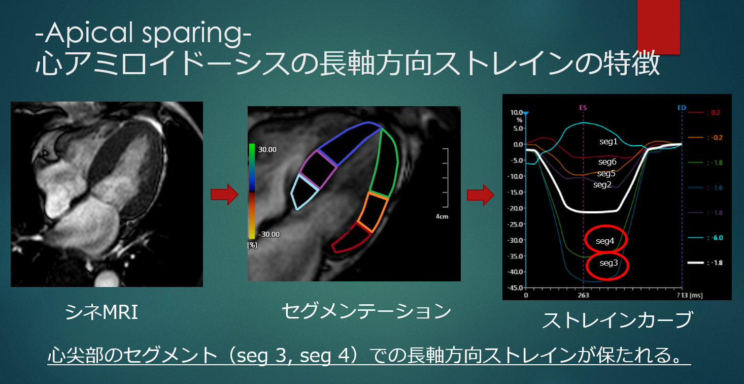心アミロイドーシスのMRI 循環器画像診断まとめ